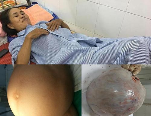 Hà Tĩnh: Bệnh nhân mang khối u 10kg, thầy bói nói có thai - 1