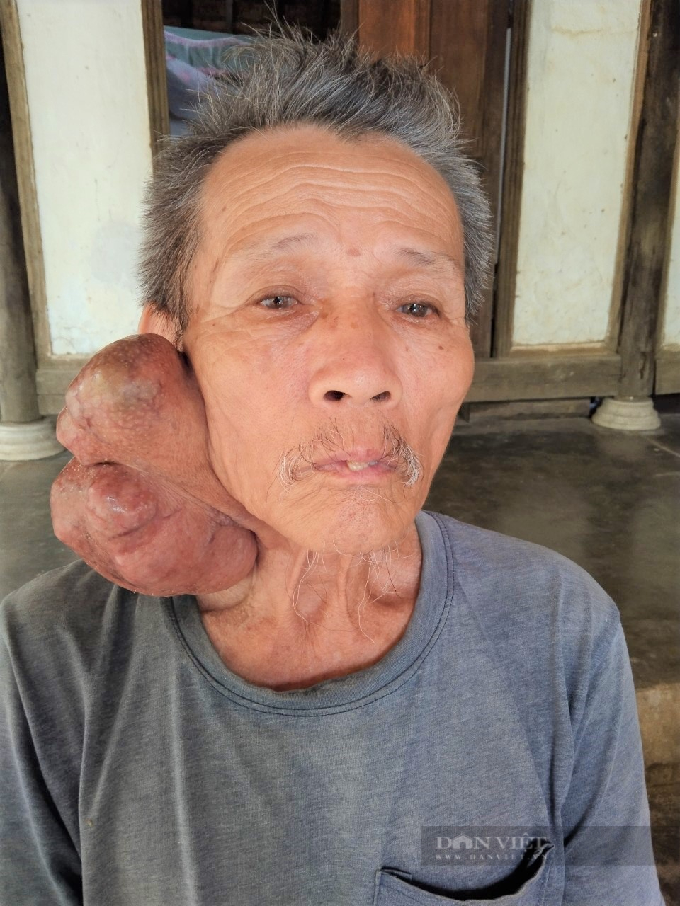 Hà Tĩnh: Nỗi khổ cụ ông 73 tuổi mang khối u lạ nặng 1kg ở cổ, bán hết cả gia tài vẫn chưa khỏi bệnh - Ảnh 1.