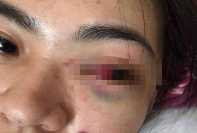 Nữ sinh ở Hà Tĩnh bị nhóm bạn đánh hội đồng dẫn đến tụ máu mắt - Ảnh 1.